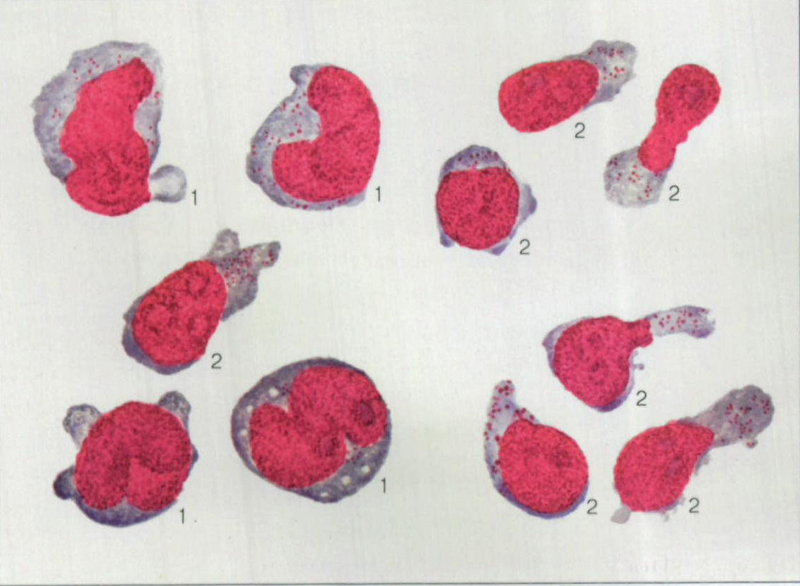 图247 恶性组织细胞病单核样及淋巴样组织细胞